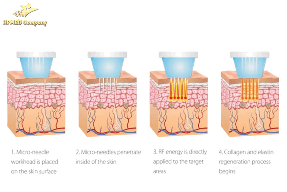 Minh họa quy trình điều trị RF vi điểm trên da với kim siêu nhỏ kích thích tái tạo collagen elastin
